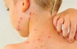 AŞI KARŞITLIĞI KIZAMIK VAKALARINI ARTIRDI