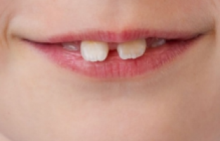 Çocuklarda diş estetiğine dikkat...